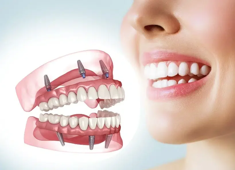 Illustration of implant-supported upper and lower dentures beside a smiling patient