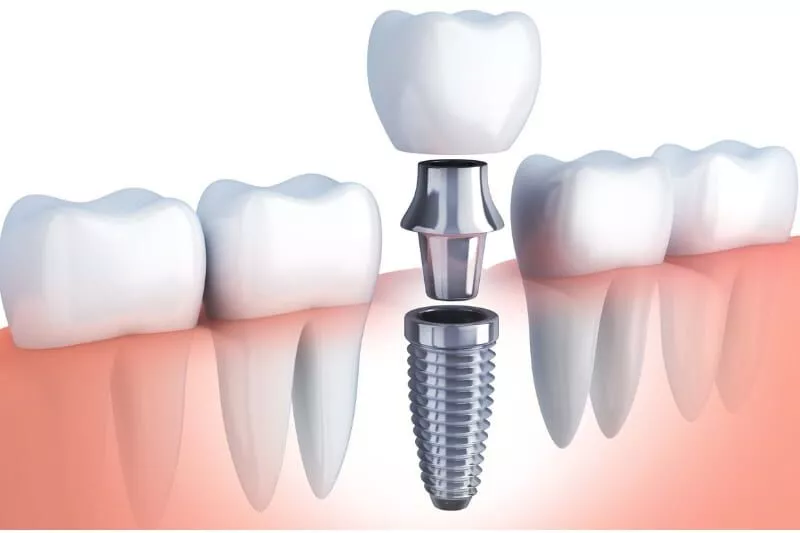 Illustration of a dental implant, abutment and crown replacing a missing tooth