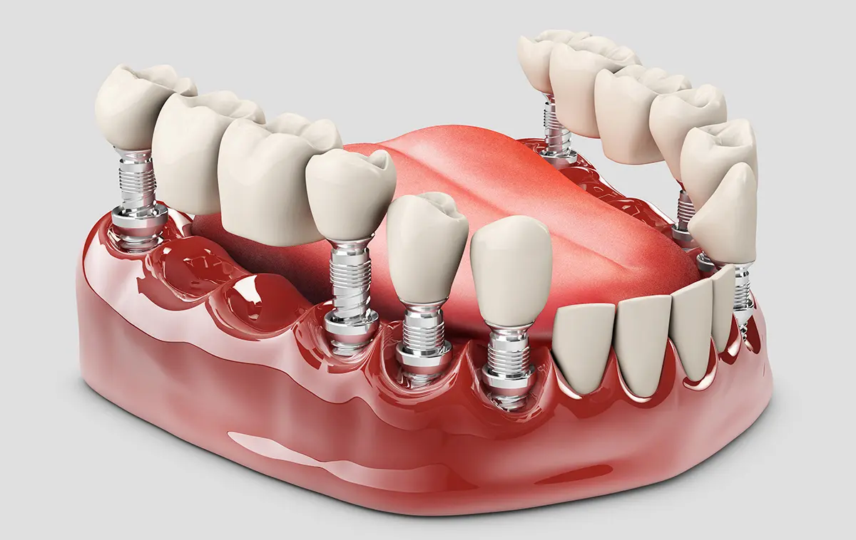 3D model of fixed upper and lower denture bridges anchored by dental implants