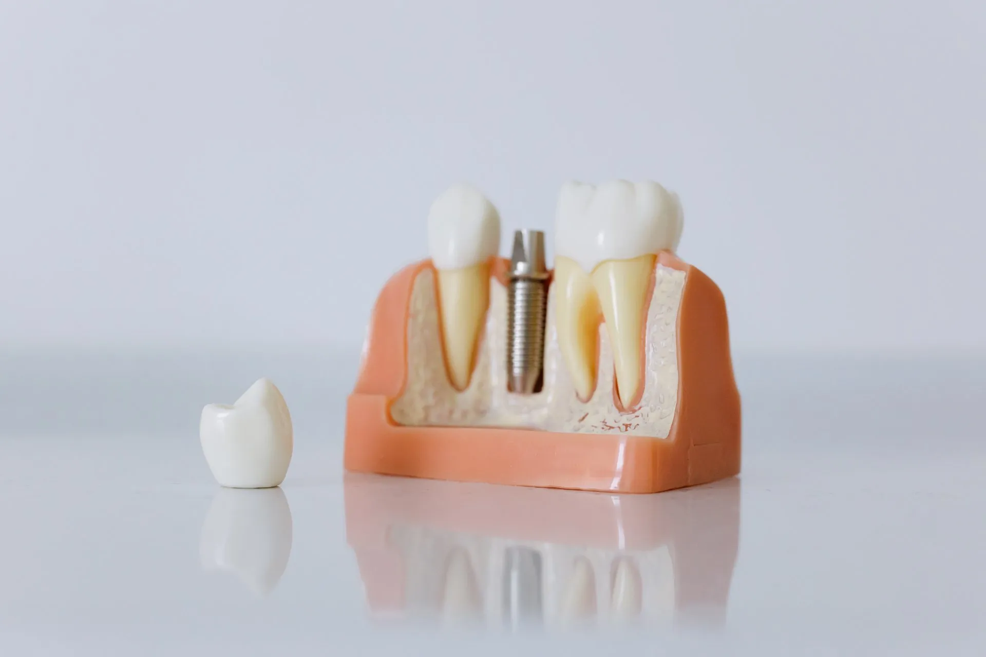 Fixed Implant Supported Denture in Venice, FL