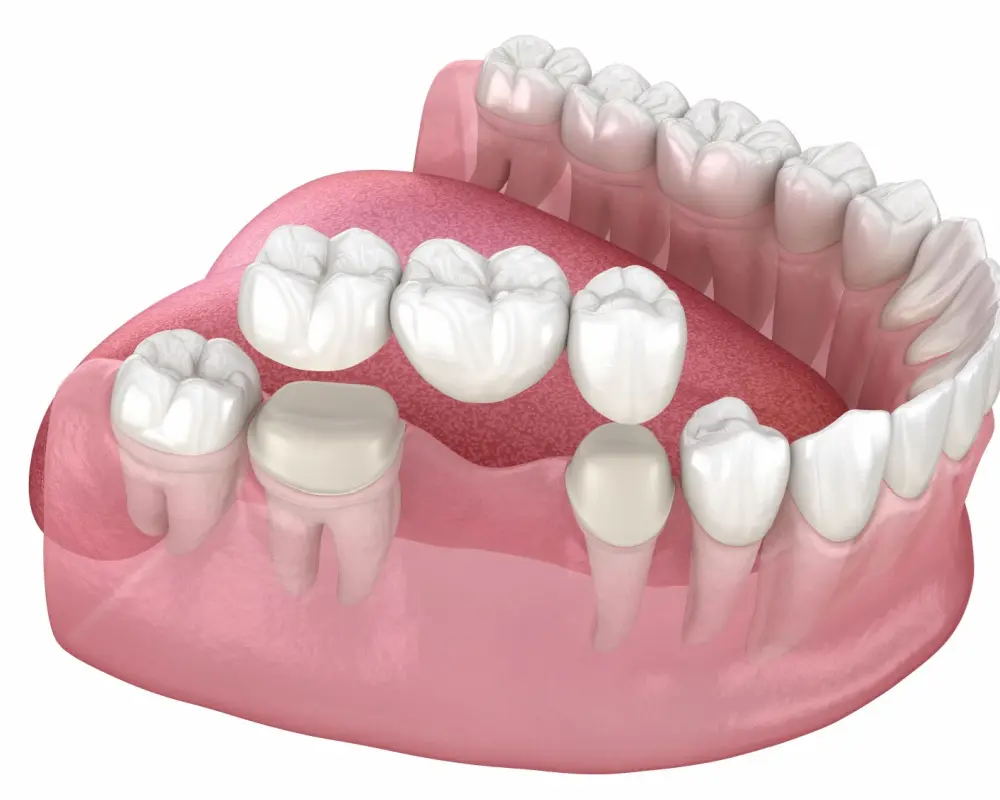 Multiple Teeth Replacement in Venice, FL