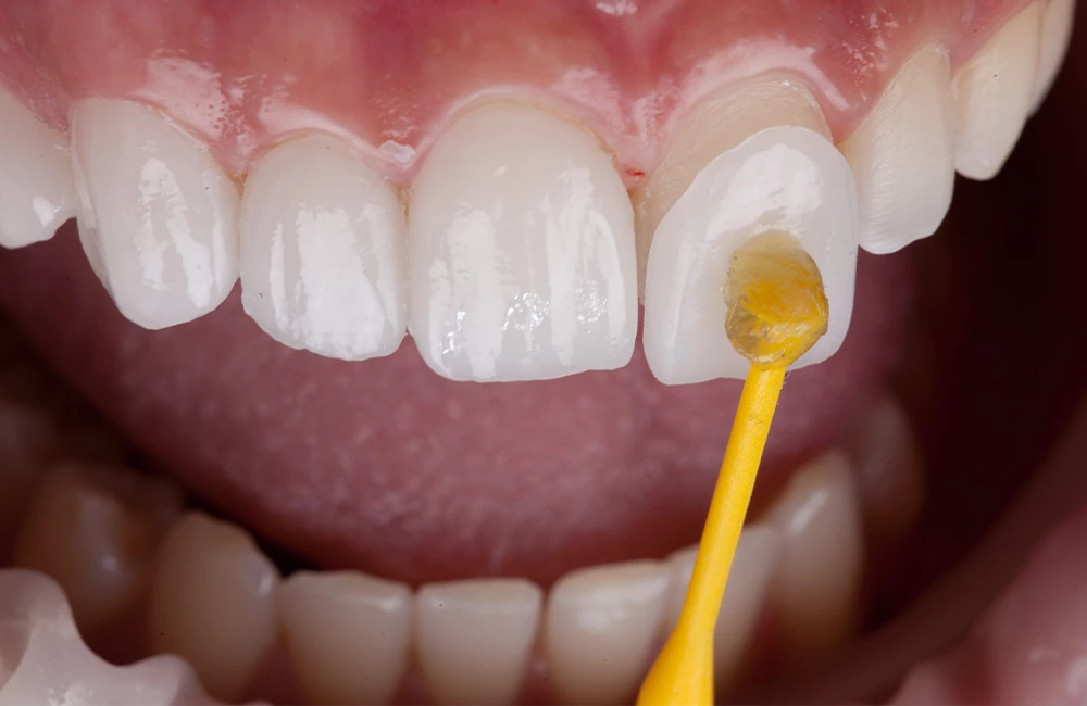 Dental shade tab being matched to a patient’s front tooth for a veneer