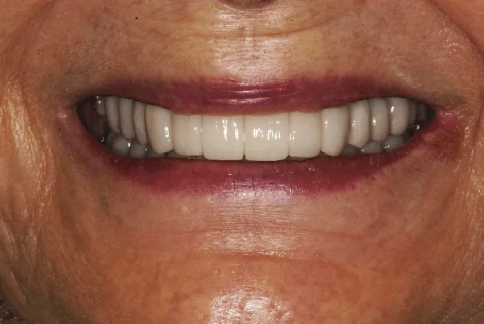 After dental transformation close up of a woman's smile